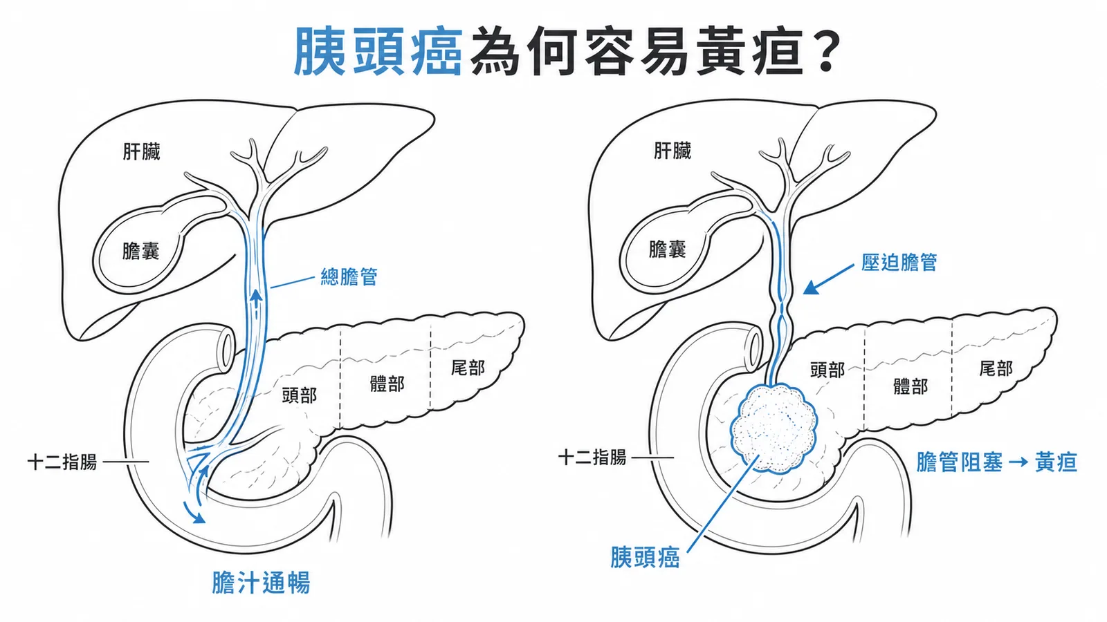 胰臟頭部腫瘤壓迫膽總管導致阻塞性黃疸的解剖示意圖