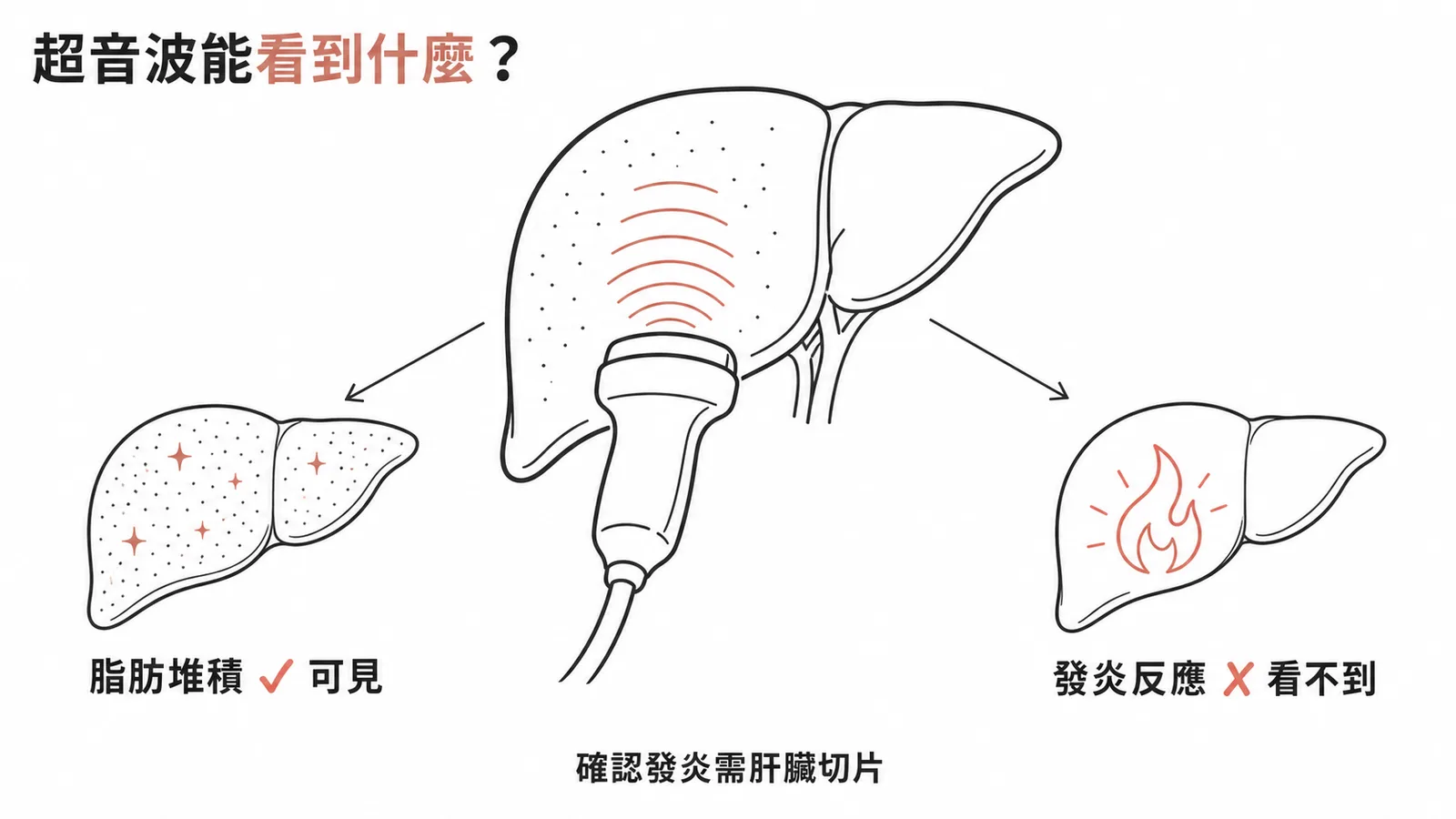 超音波可見脂肪堆積但無法判斷發炎反應的限制示意圖