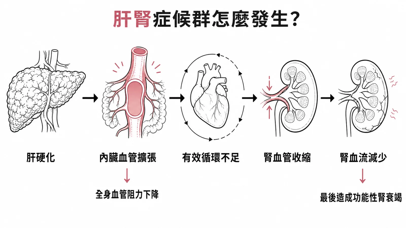 肝腎症候群的血流動力學機轉流程示意圖