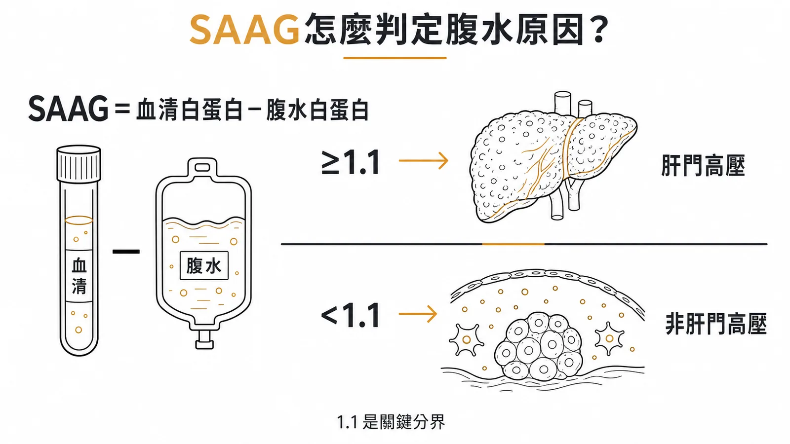 SAAG公式與1.1門檻判定肝門高壓腹水的示意圖