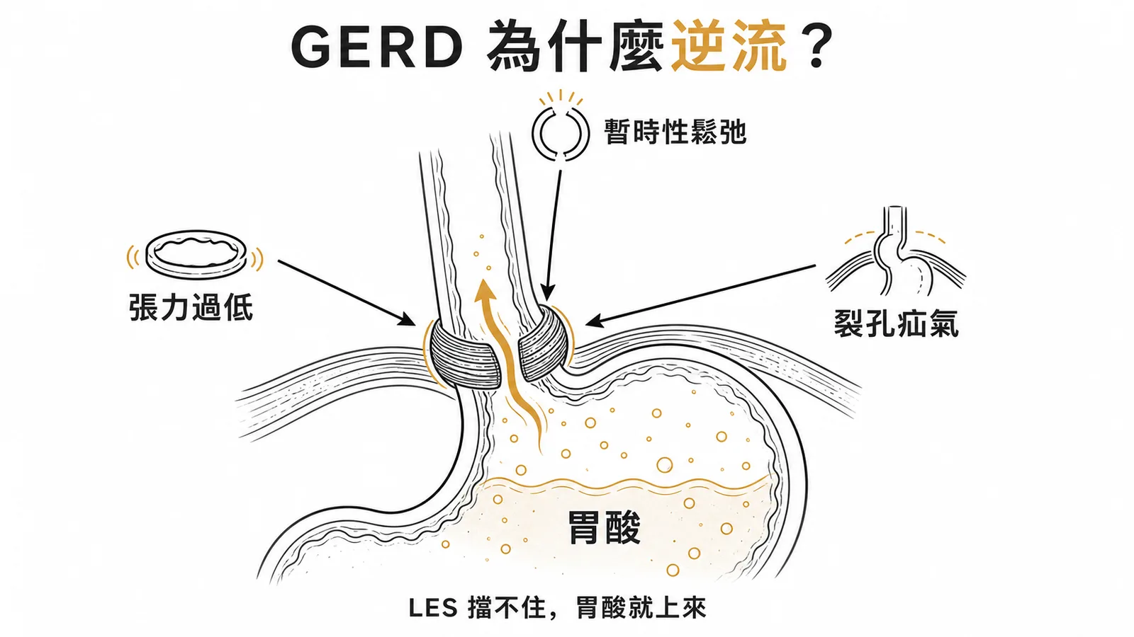 GERD三大致病機轉與食道下括約肌功能異常示意圖