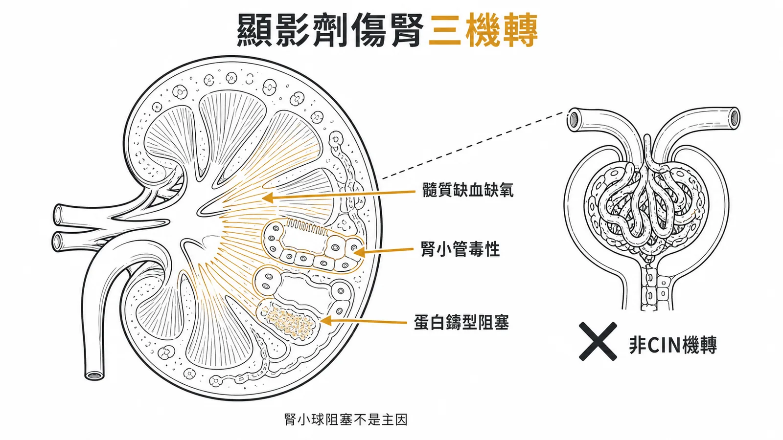 顯影劑腎損傷三大機轉與腎小球非CIN機轉對比示意圖