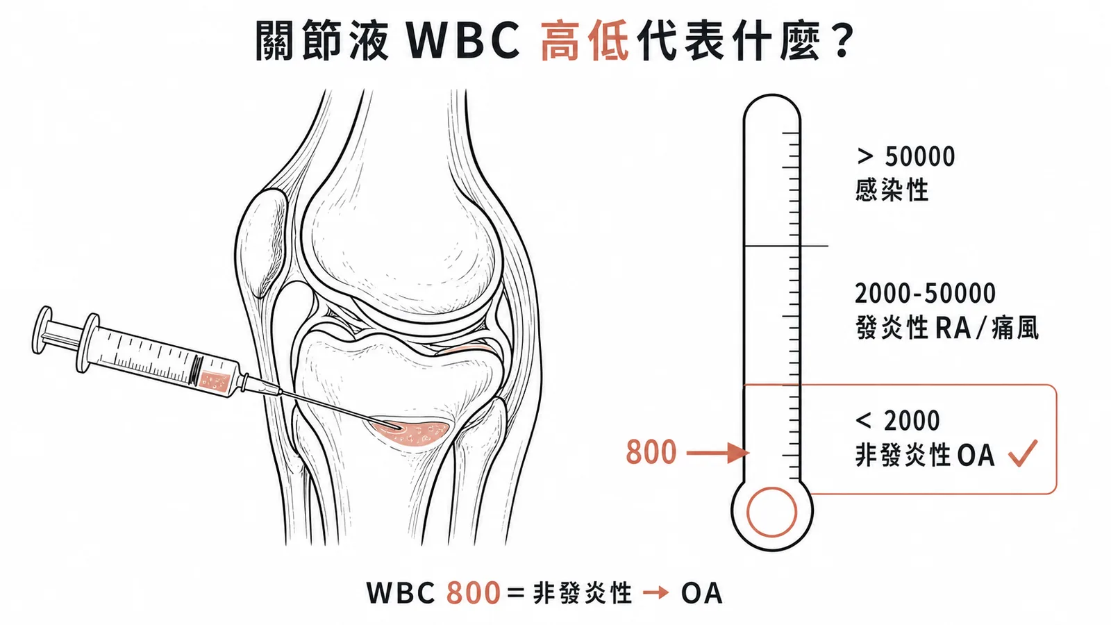 關節液 WBC 鑑別：小於 2000 為非發炎性（退化性關節炎），2000 至 50000 為發炎性（RA 或痛風），大於 50000 為感染性