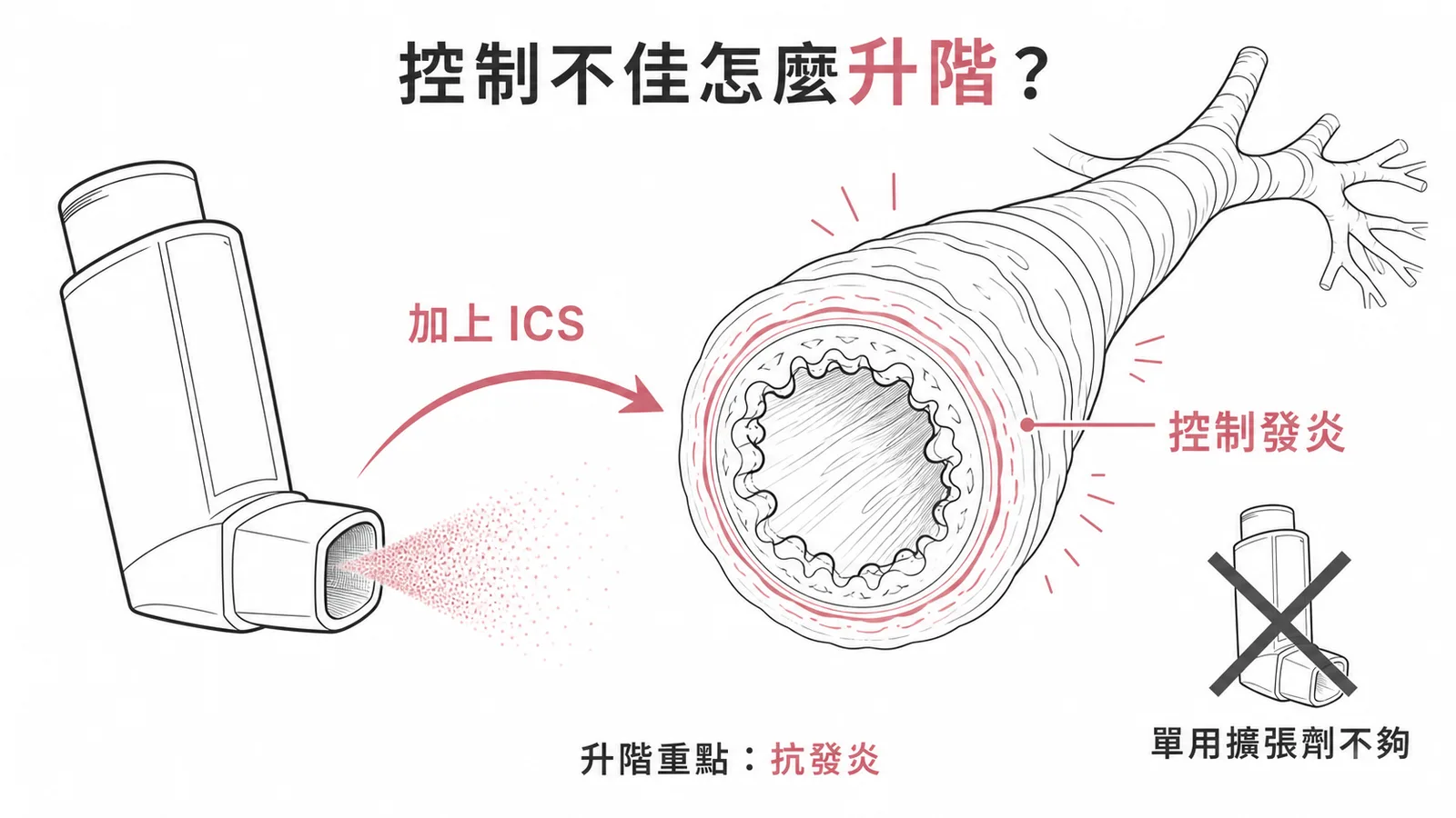 氣喘升階治療示意圖：加上吸入性類固醇控制發炎，單用擴張劑不夠