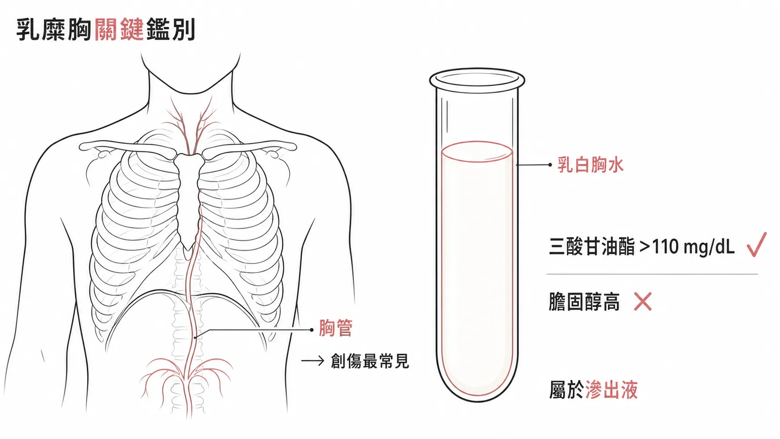 乳糜胸鑑別：三酸甘油酯>110為真乳糜胸，膽固醇高為假性