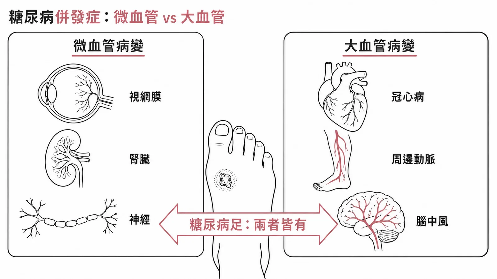 糖尿病慢性併發症分類：微血管vs大血管，糖尿病足兩者皆有