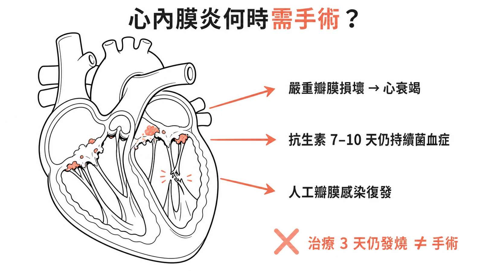 心內膜炎手術適應症：心衰竭、持續菌血症、人工瓣膜復發，治療3天發燒不算