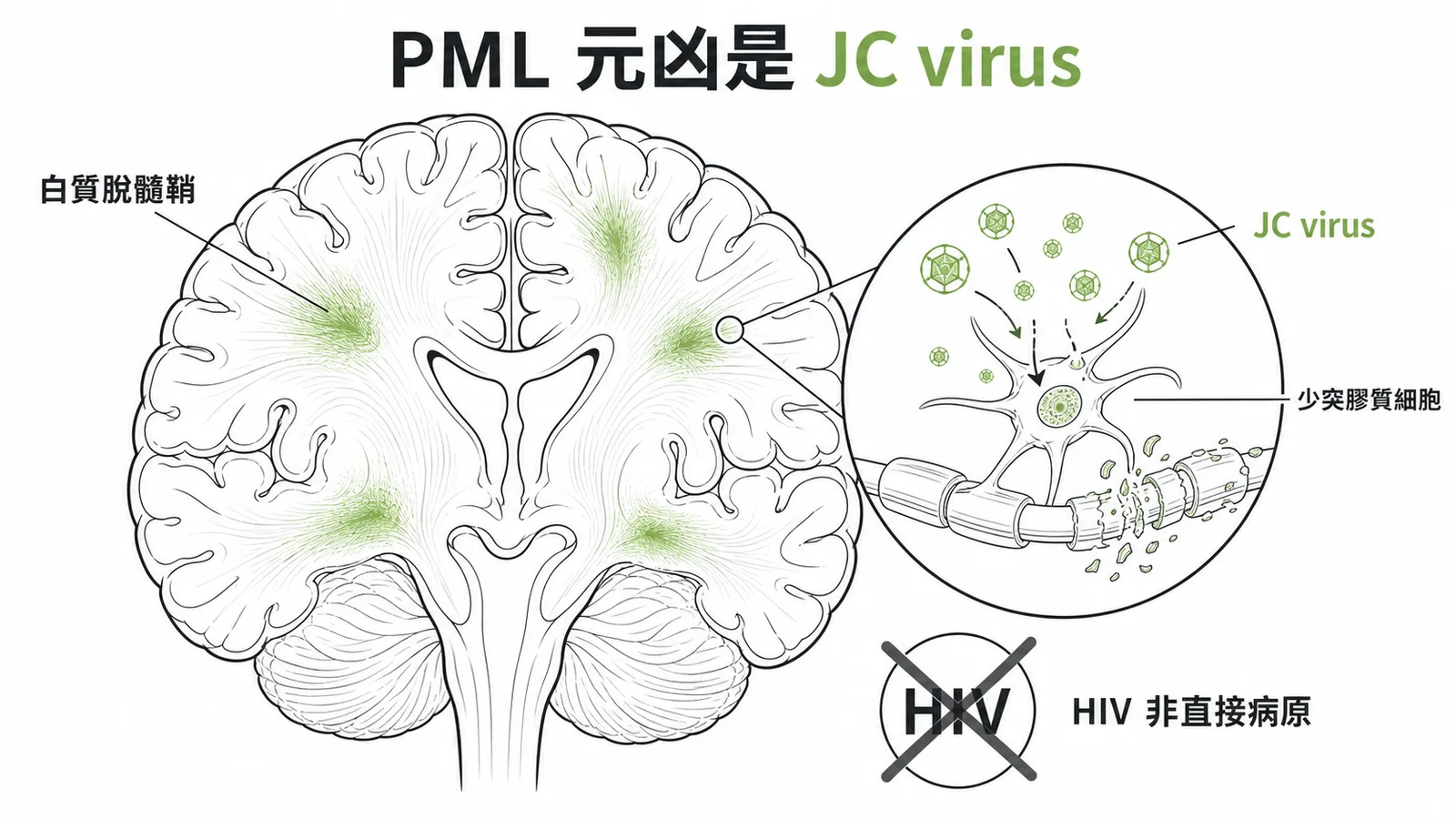PML由JC virus攻擊少突膠質細胞引起，HIV只是免疫抑制因素