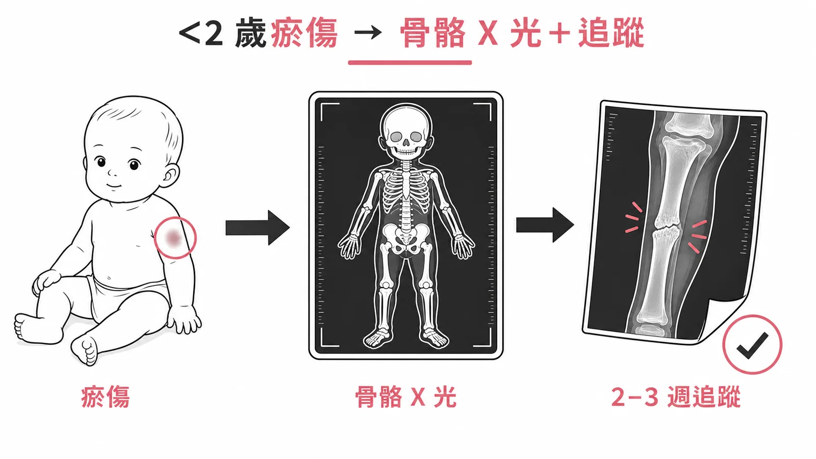 兒虐骨骼影像檢查流程：小於二歲瘀傷到骨骼X光再追蹤