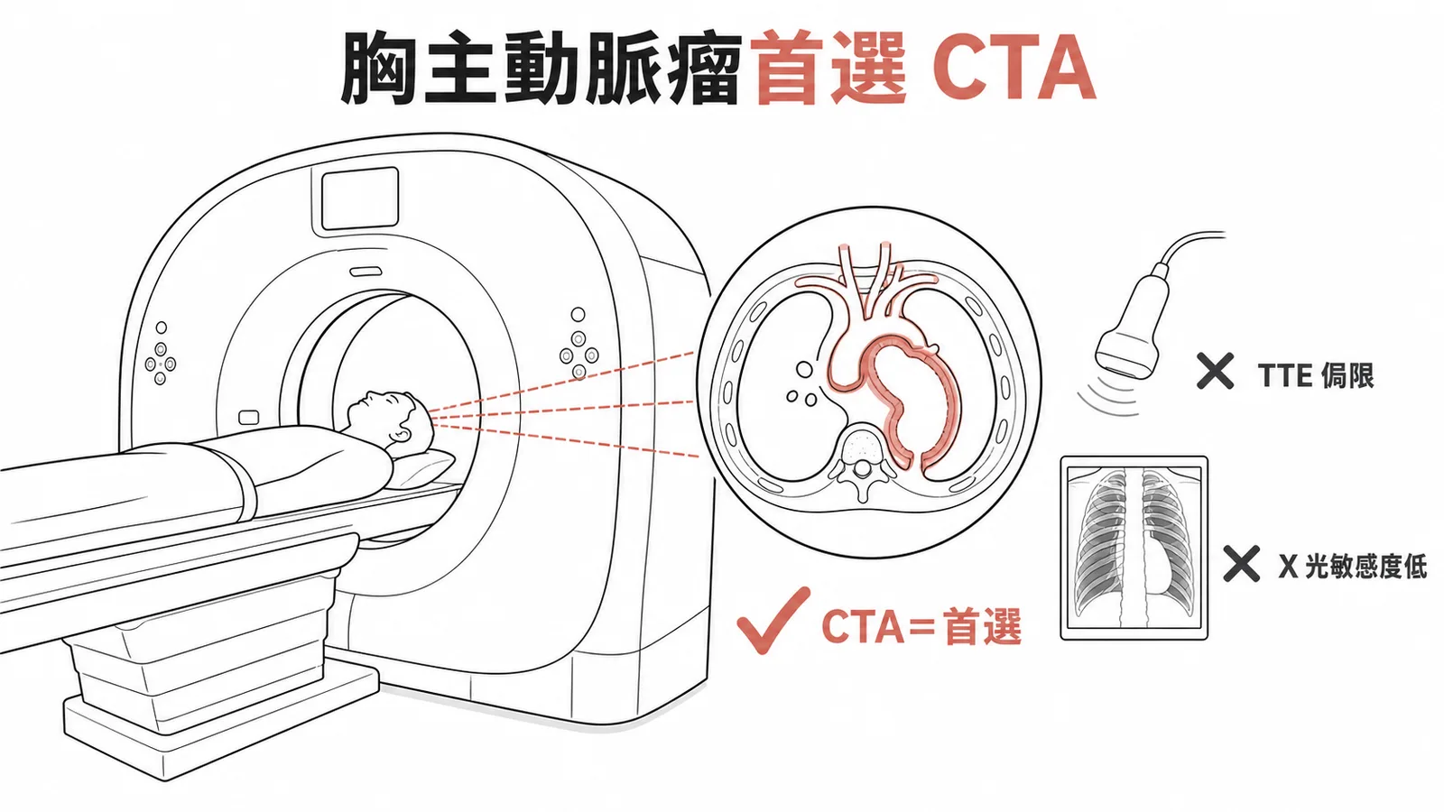 胸主動脈瘤首選CTA診斷示意圖