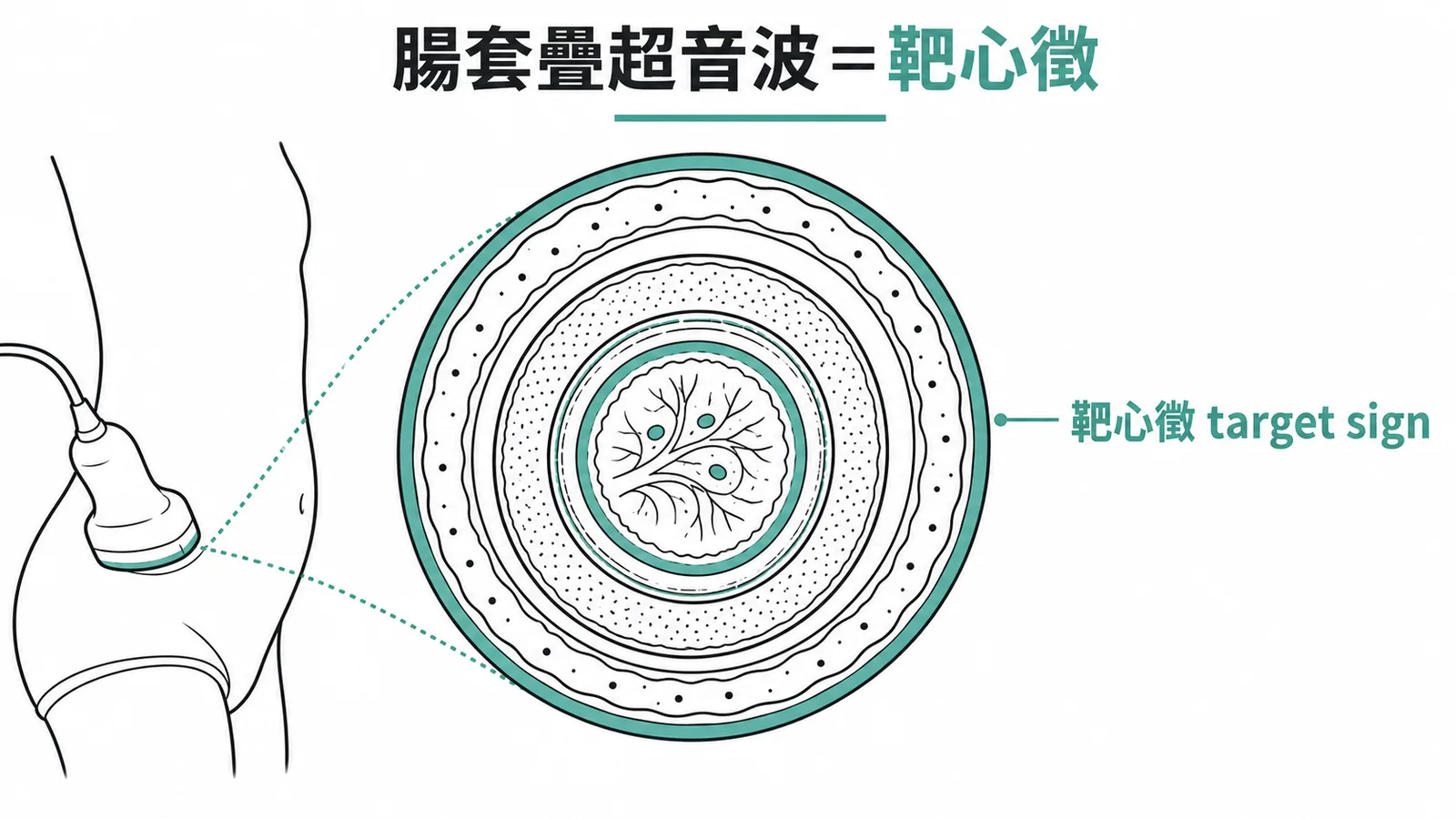 腸套疊超音波靶心徵同心圓結構示意圖