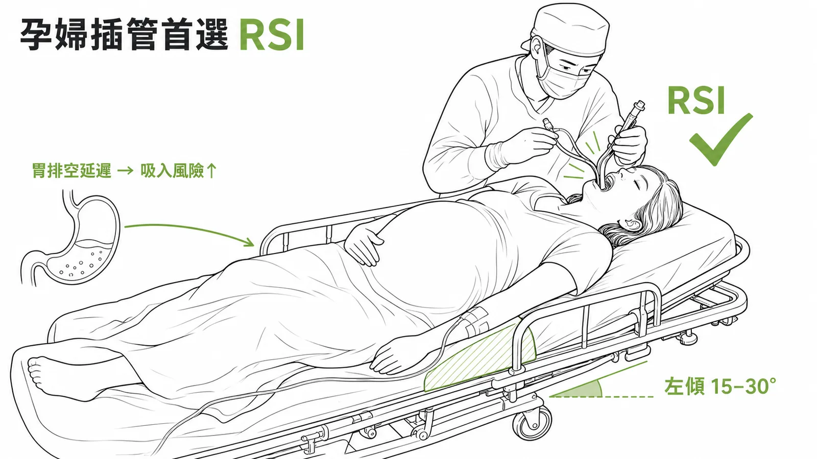 孕婦插管首選RSI因胃排空延遲吸入風險高