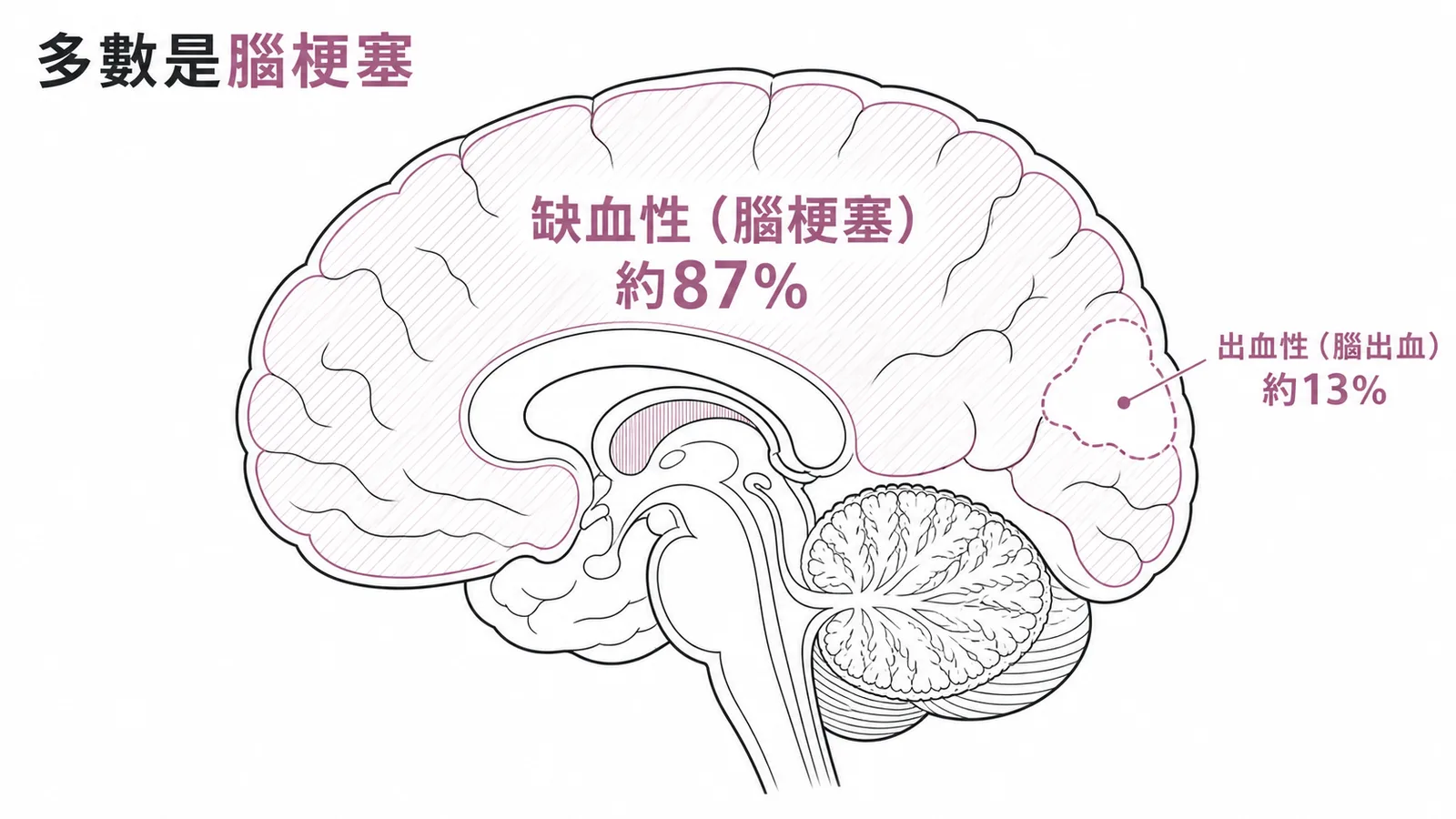 腦中風類型比例示意圖,缺血性腦梗塞約87%遠大於出血性腦出血約13%