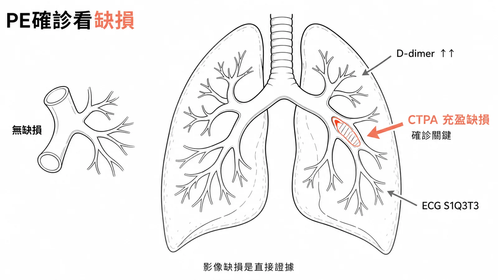 肺栓塞診斷金三角示意圖，CTPA充盈缺損加D-dimer升高加ECG S1Q3T3
