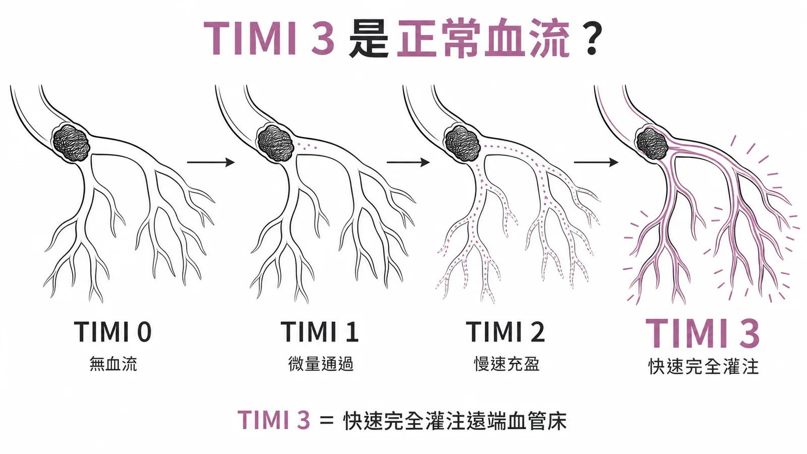 TIMI血流分級從TIMI 0無血流到TIMI 3正常完全灌注