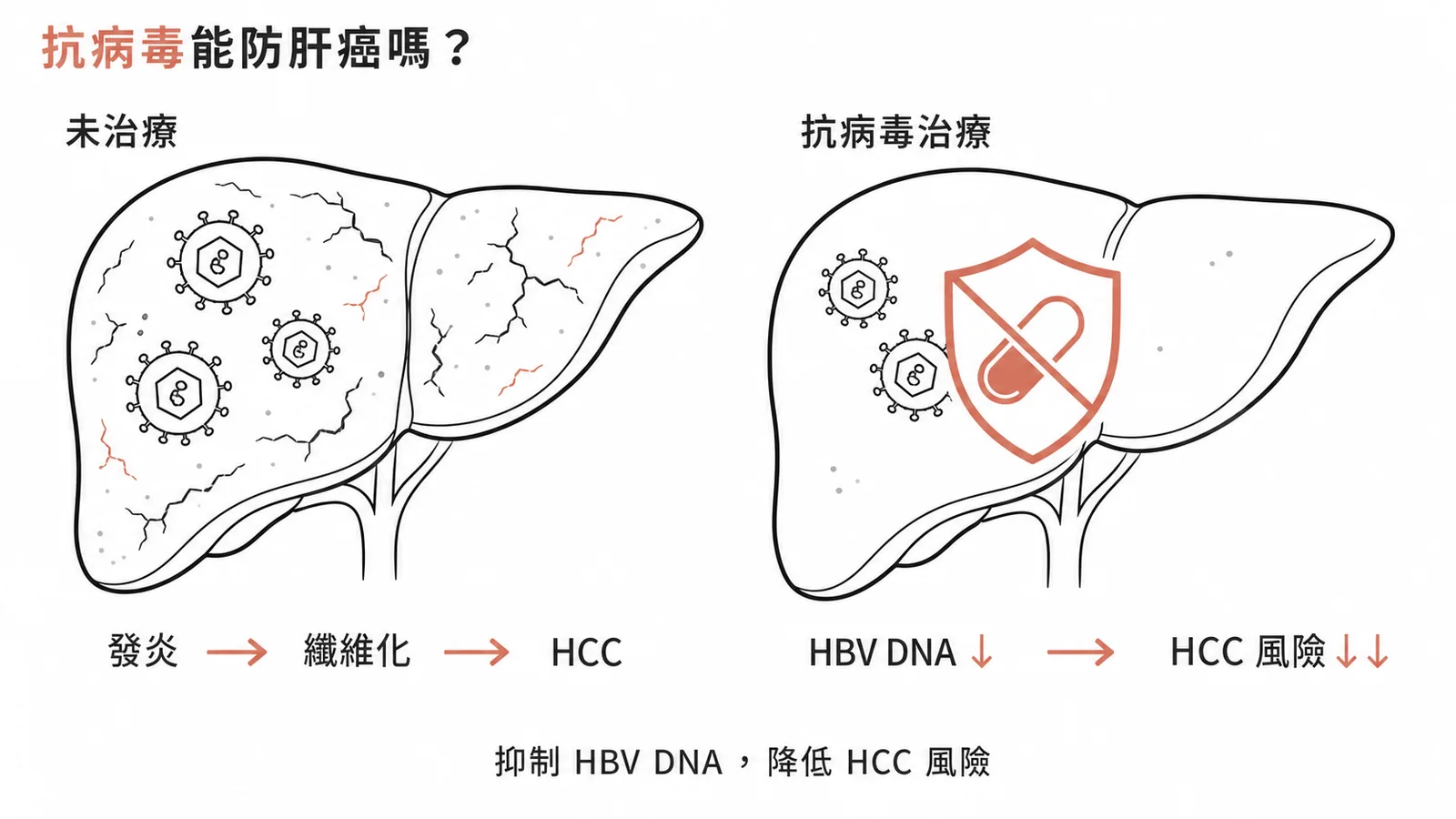 抗病毒治療抑制HBV DNA可顯著降低慢性B肝患者肝細胞癌風險