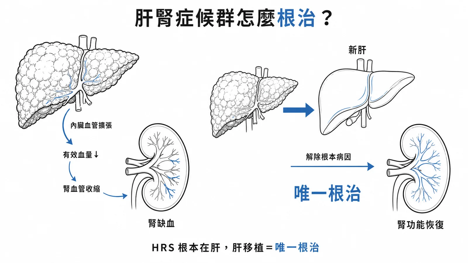 肝腎症候群 HRS 是功能性腎衰竭,根本病因在肝臟,肝移植是唯一根治方法