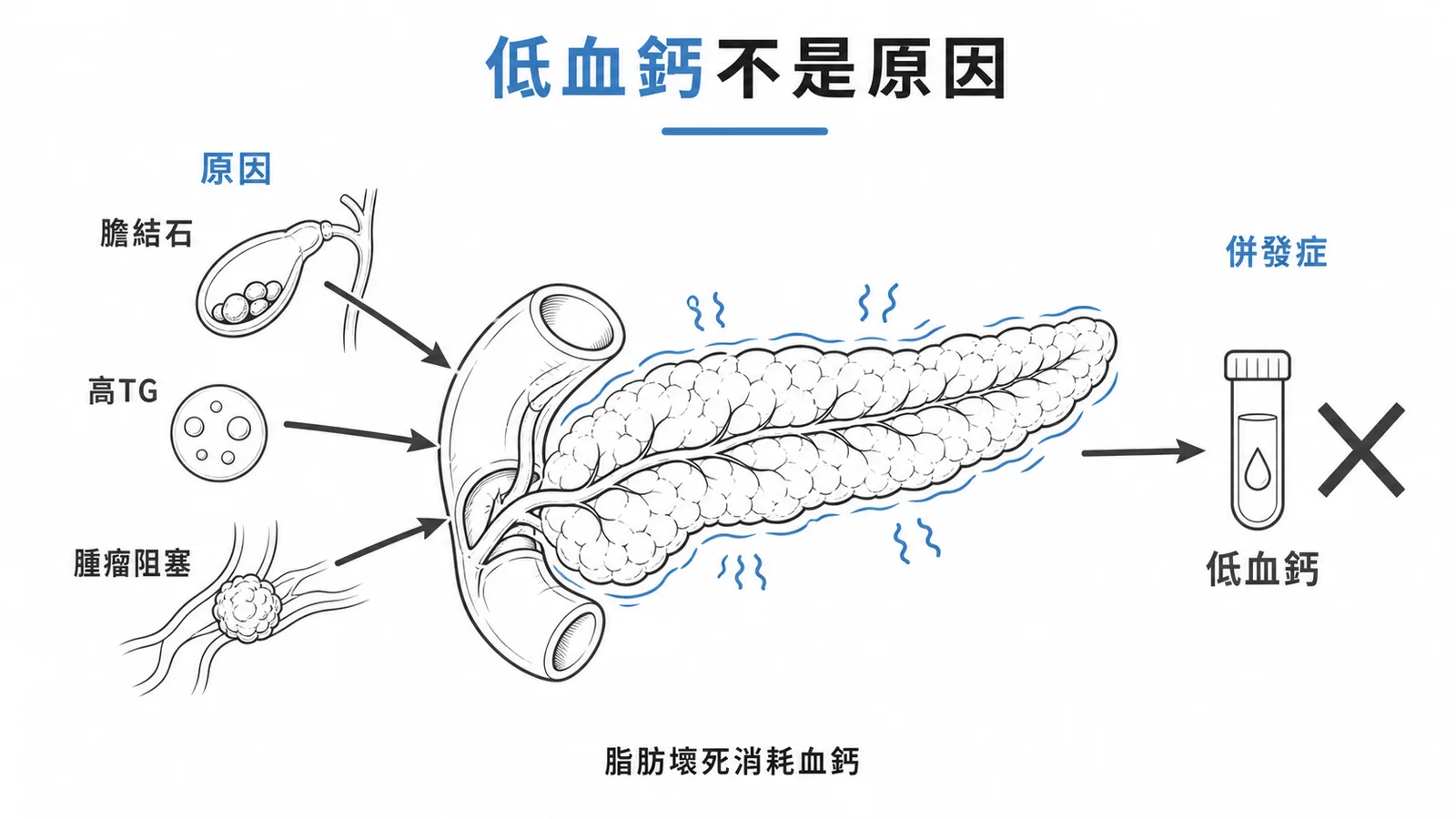 急性胰臟炎原因與併發症對照：膽結石、高三酸甘油酯及腫瘤是原因，低血鈣是併發症