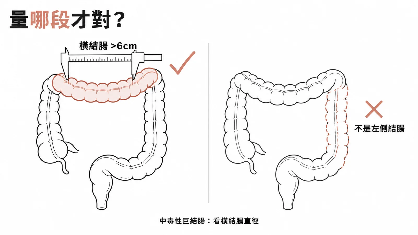 中毒性巨結腸診斷：橫結腸直徑大於六公分，非左側結腸