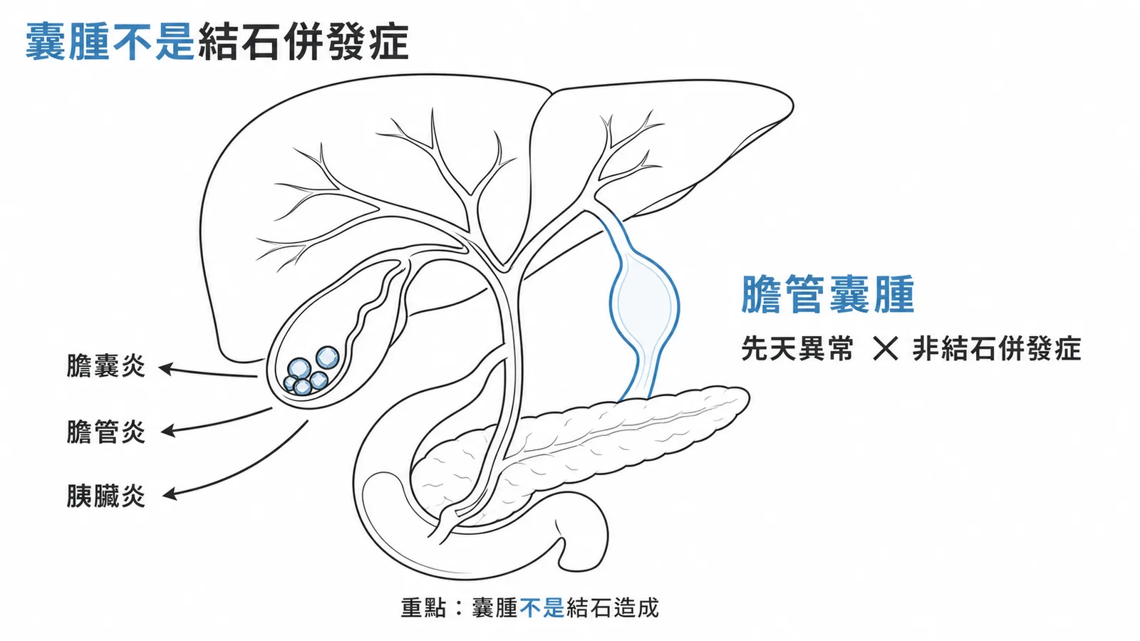 膽結石併發症對照:膽囊炎、膽管炎、胰臟炎是併發症,膽管囊腫是先天異常非併發症