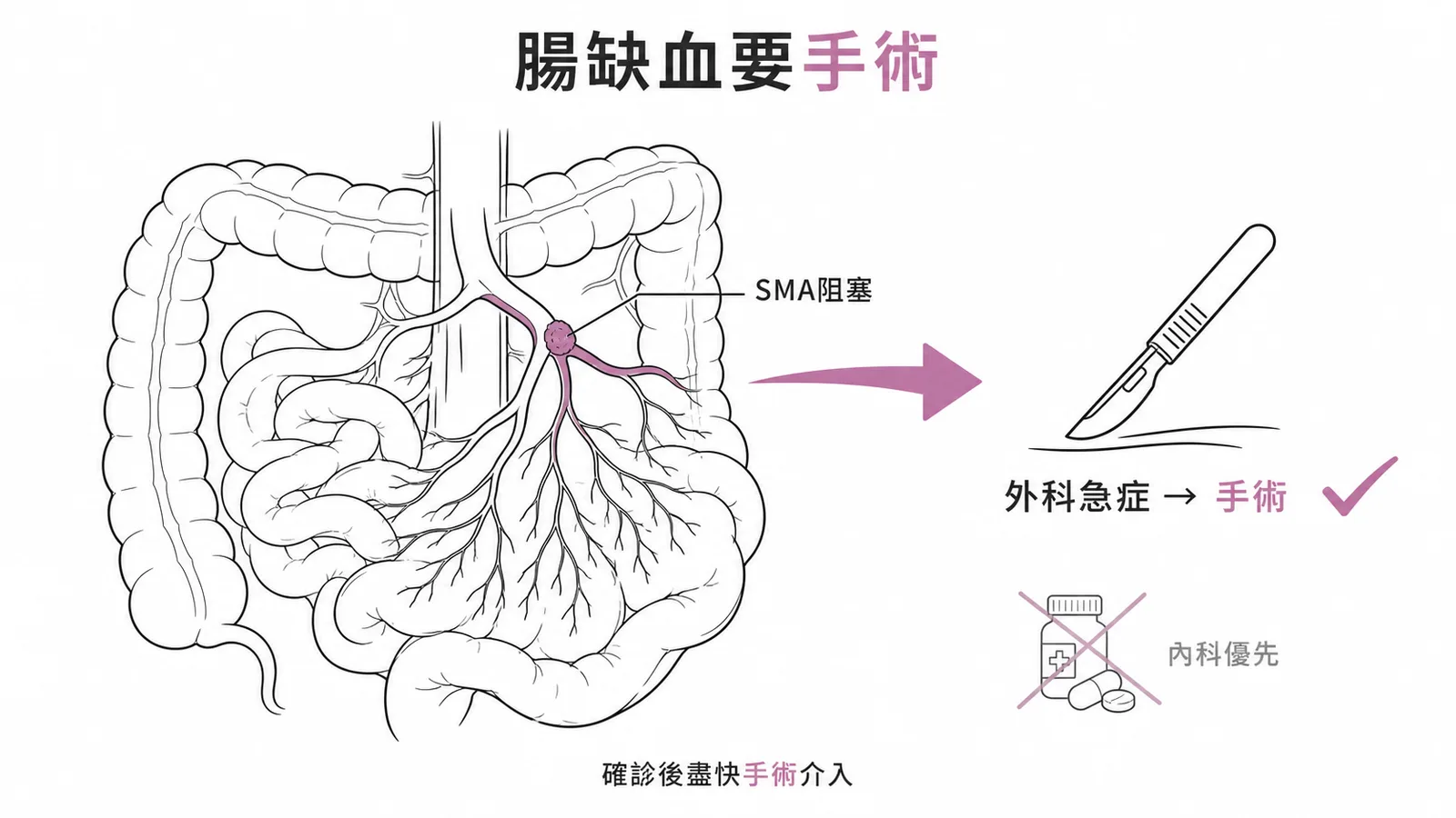 急性腸繫膜缺血是外科急症需手術介入，非以內科治療優先