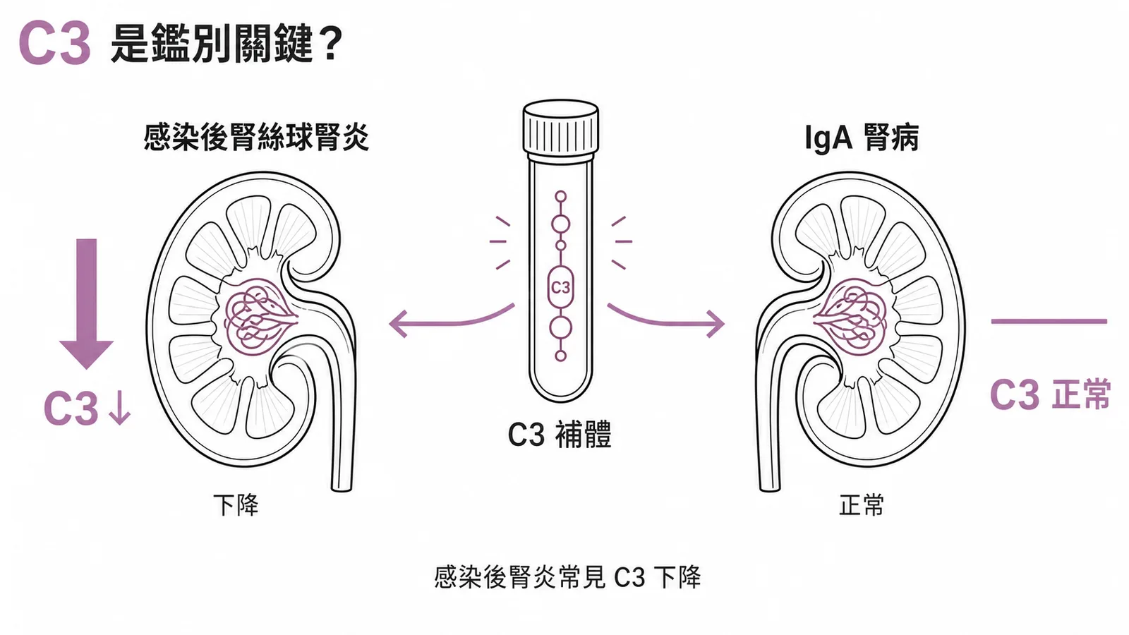 感染後腎絲球腎炎與IgA腎病的鑑別：C3補體下降是關鍵指標