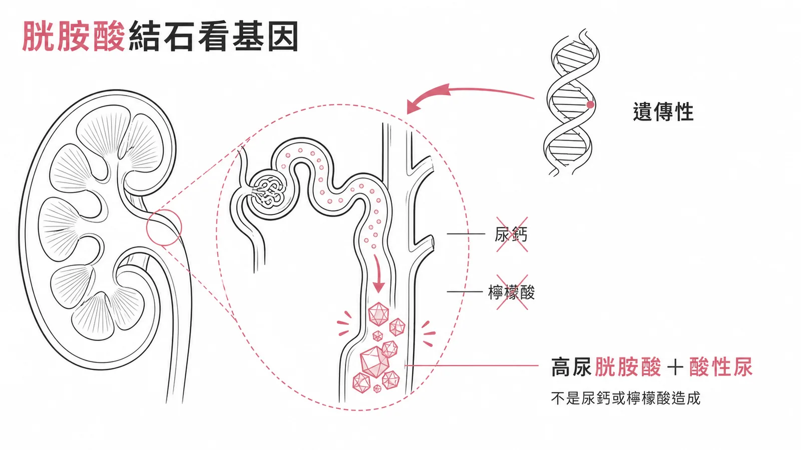 四種腎結石危險因子對照:胱胺酸結石是遺傳性疾病與尿鈣無關
