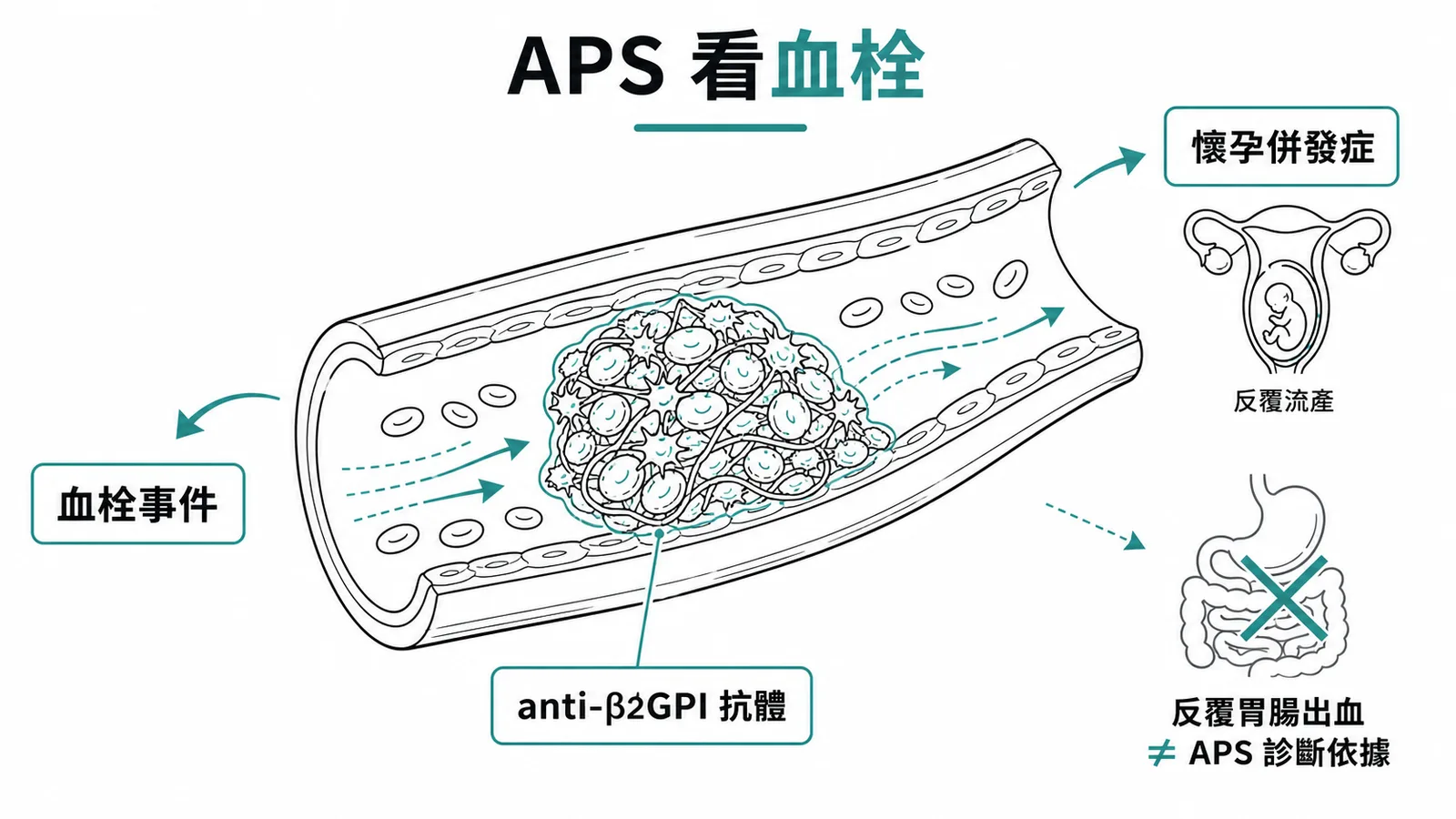 抗磷脂症候群診斷標準示意圖