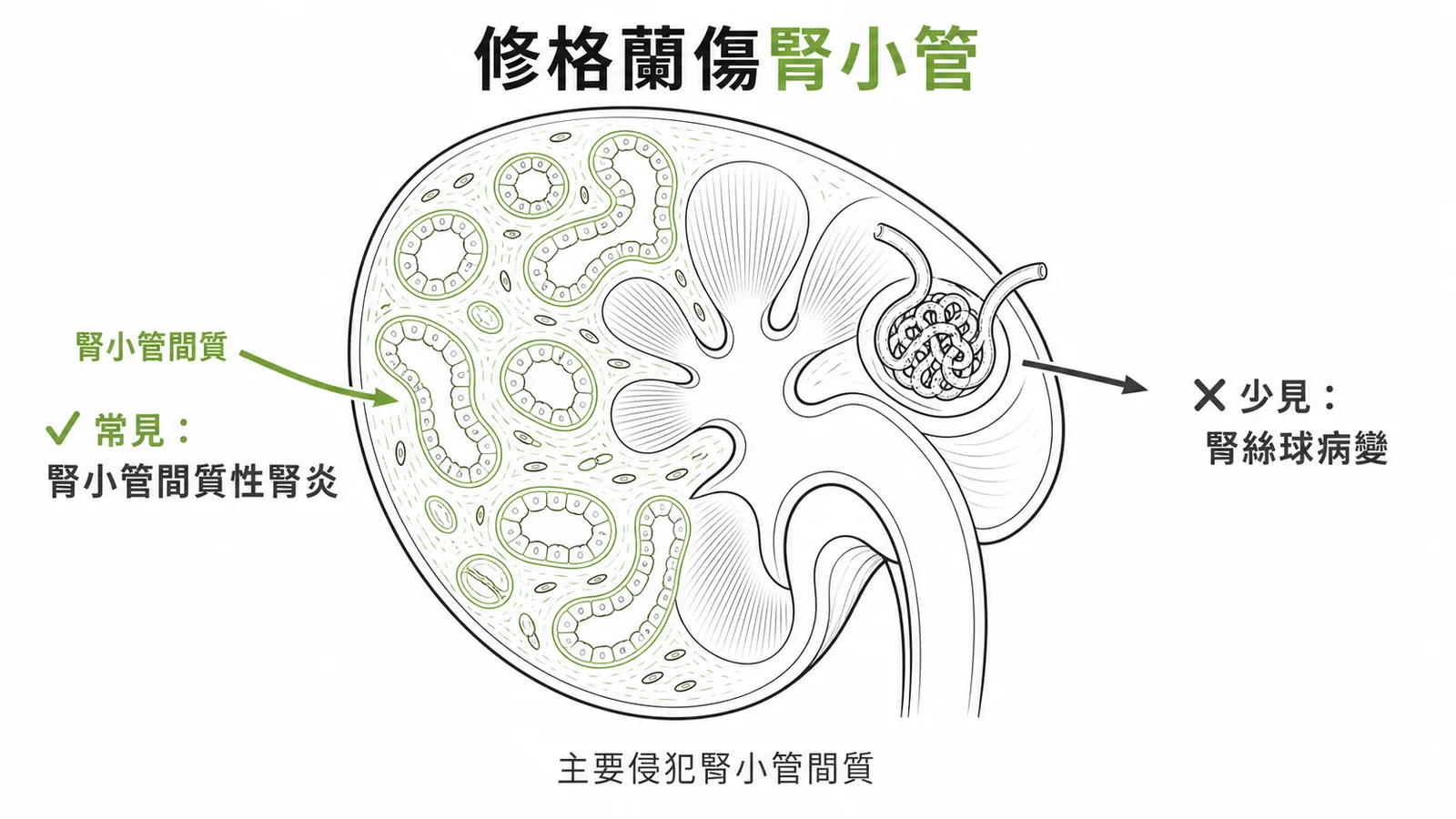 修格蘭氏症候群腎臟病變以腎小管間質性腎炎為主的示意圖