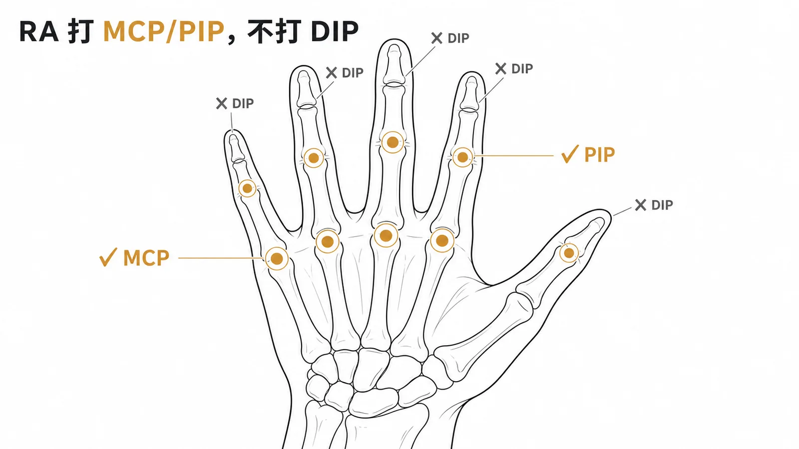 類風濕性關節炎好發 MCP 與 PIP 但不侵犯 DIP 的示意圖
