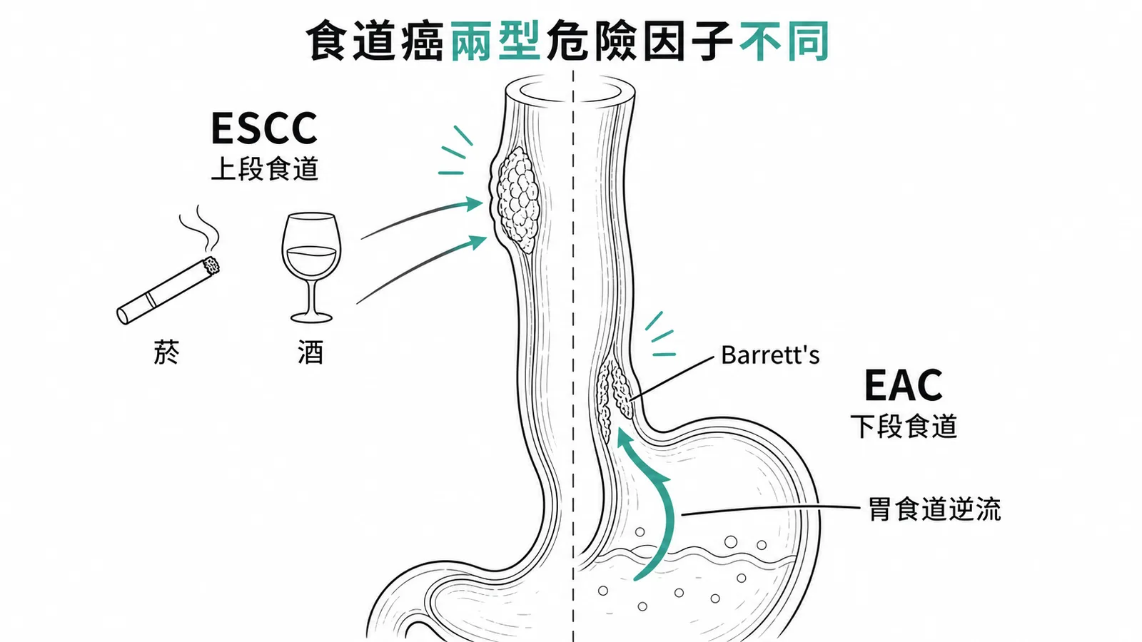 食道鱗狀上皮癌與腺癌的危險因子對照示意圖