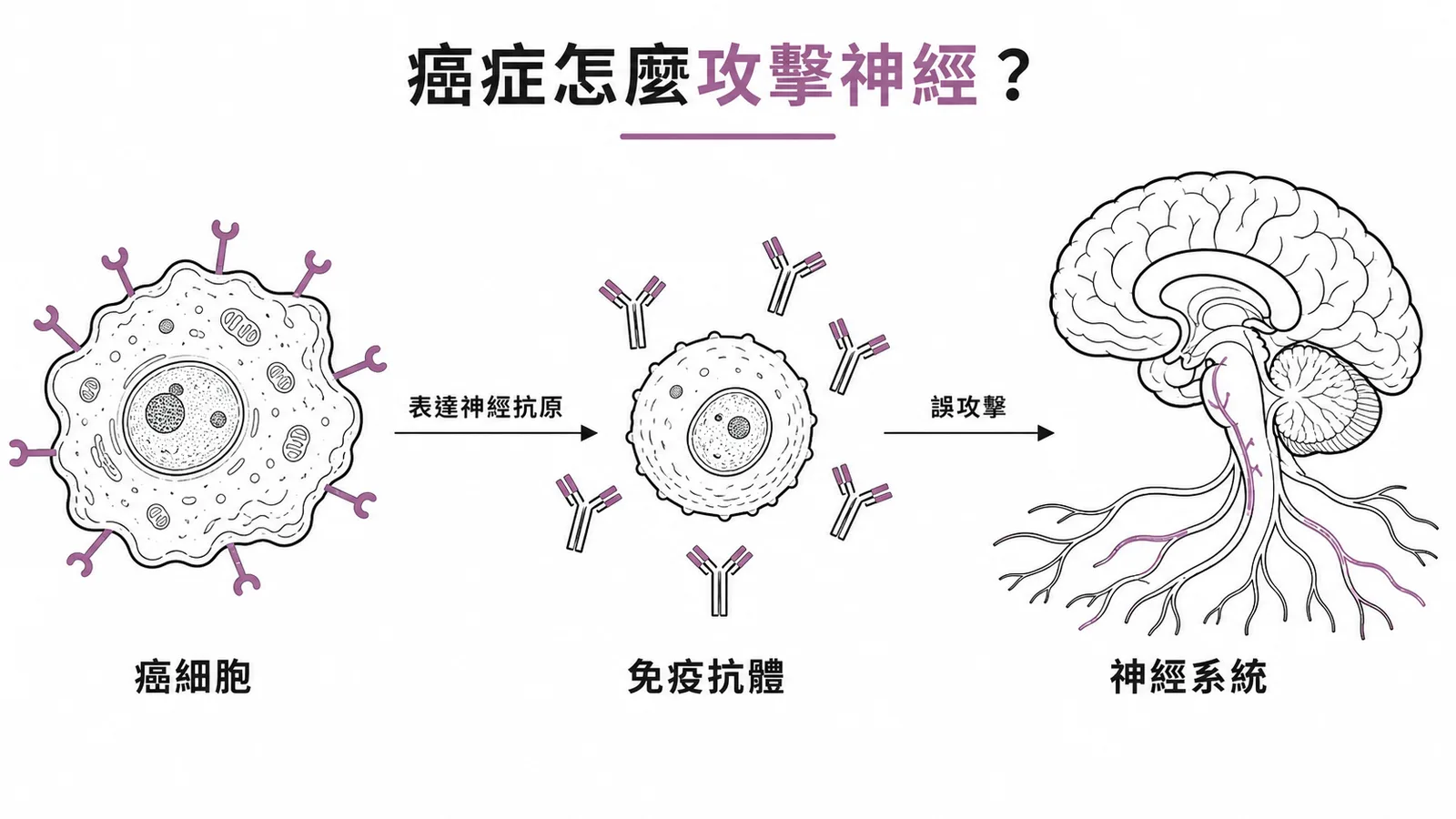 副腫瘤神經症候群機轉:癌細胞表達神經抗原引發免疫攻擊神經系統