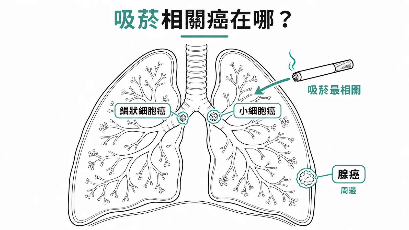 肺癌組織型態與位置:中央型鱗狀細胞癌及小細胞癌與吸菸最相關