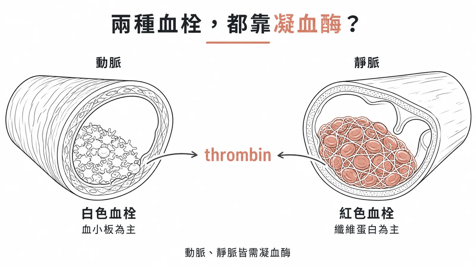 動脈血栓以血小板為主（白色血栓）vs 靜脈血栓以纖維蛋白為主（紅色血栓）的對照圖