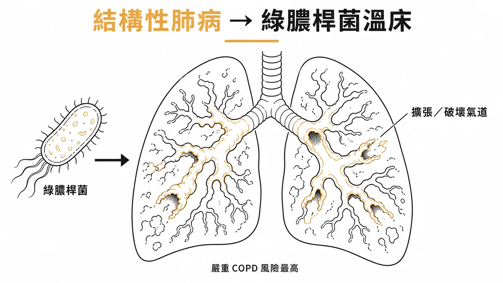 嚴重COPD等結構性肺病是綠膿桿菌社區肺炎高風險因子示意圖