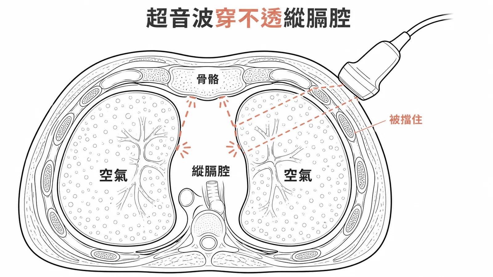 胸腔超音波無法穿透空氣和骨骼,看不到深層縱膈腔
