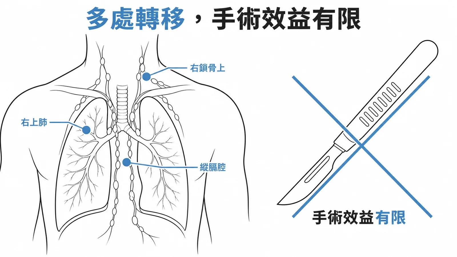 局部晚期多處淋巴結轉移時手術效益有限,應以全身性治療加放療為主