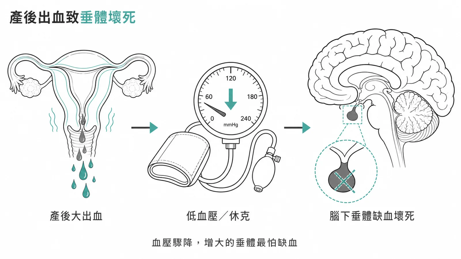 希漢氏症候群的機制：產後大出血導致腦下垂體缺血壞死