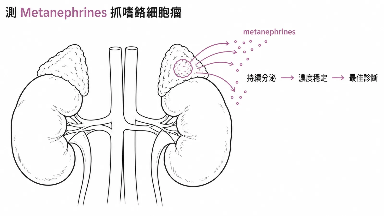 血漿游離metanephrines是診斷嗜鉻細胞瘤敏感度最高的生化檢查