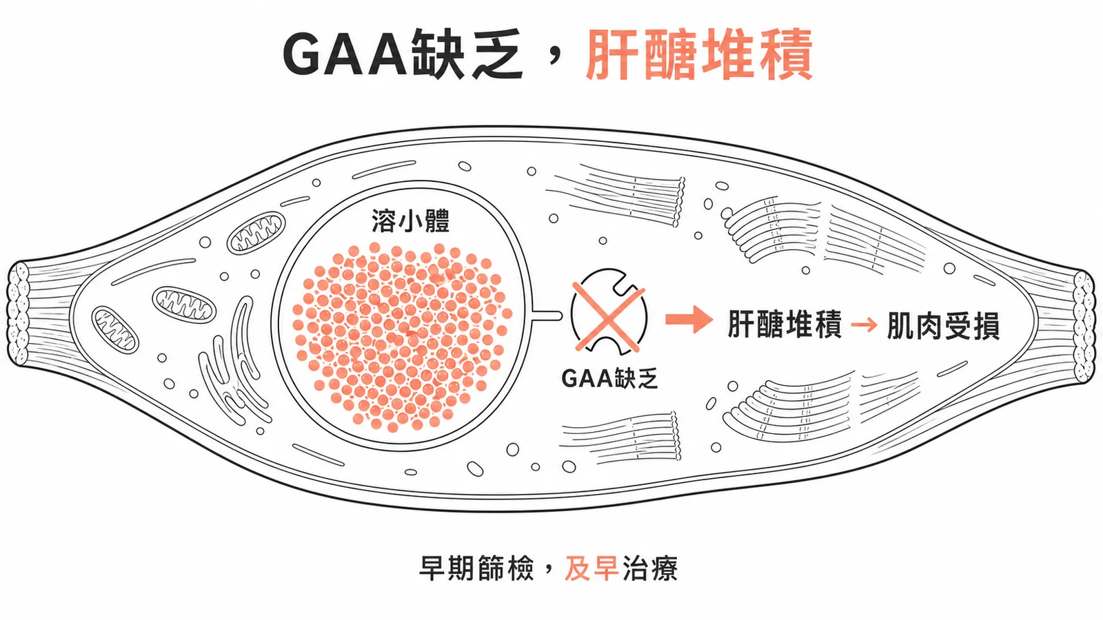 龐貝氏症是GAA酵素缺乏導致肝醣堆積在肌肉細胞的溶小體儲積症