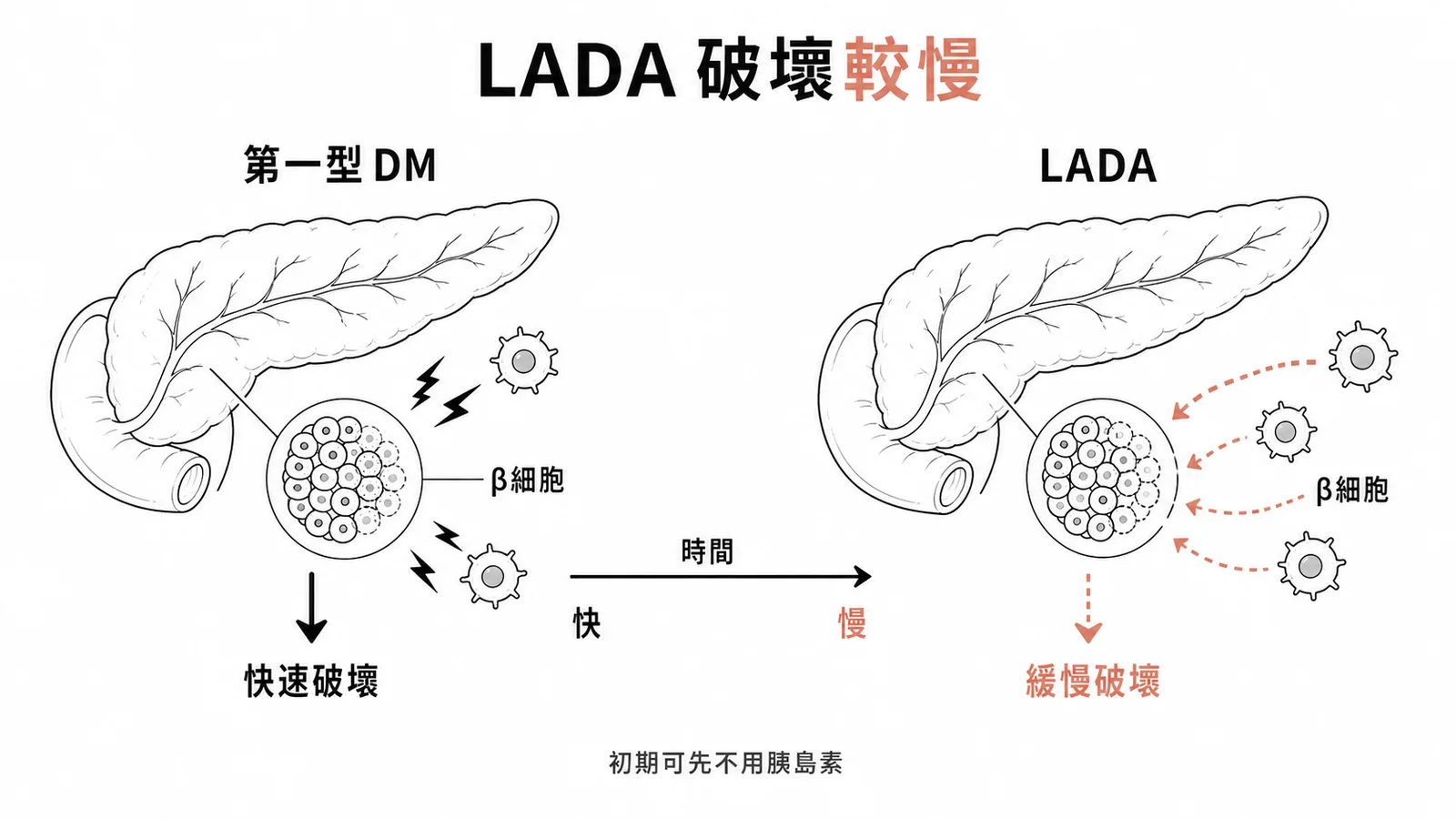 LADA的β細胞破壞速度比典型第一型糖尿病慢而非快