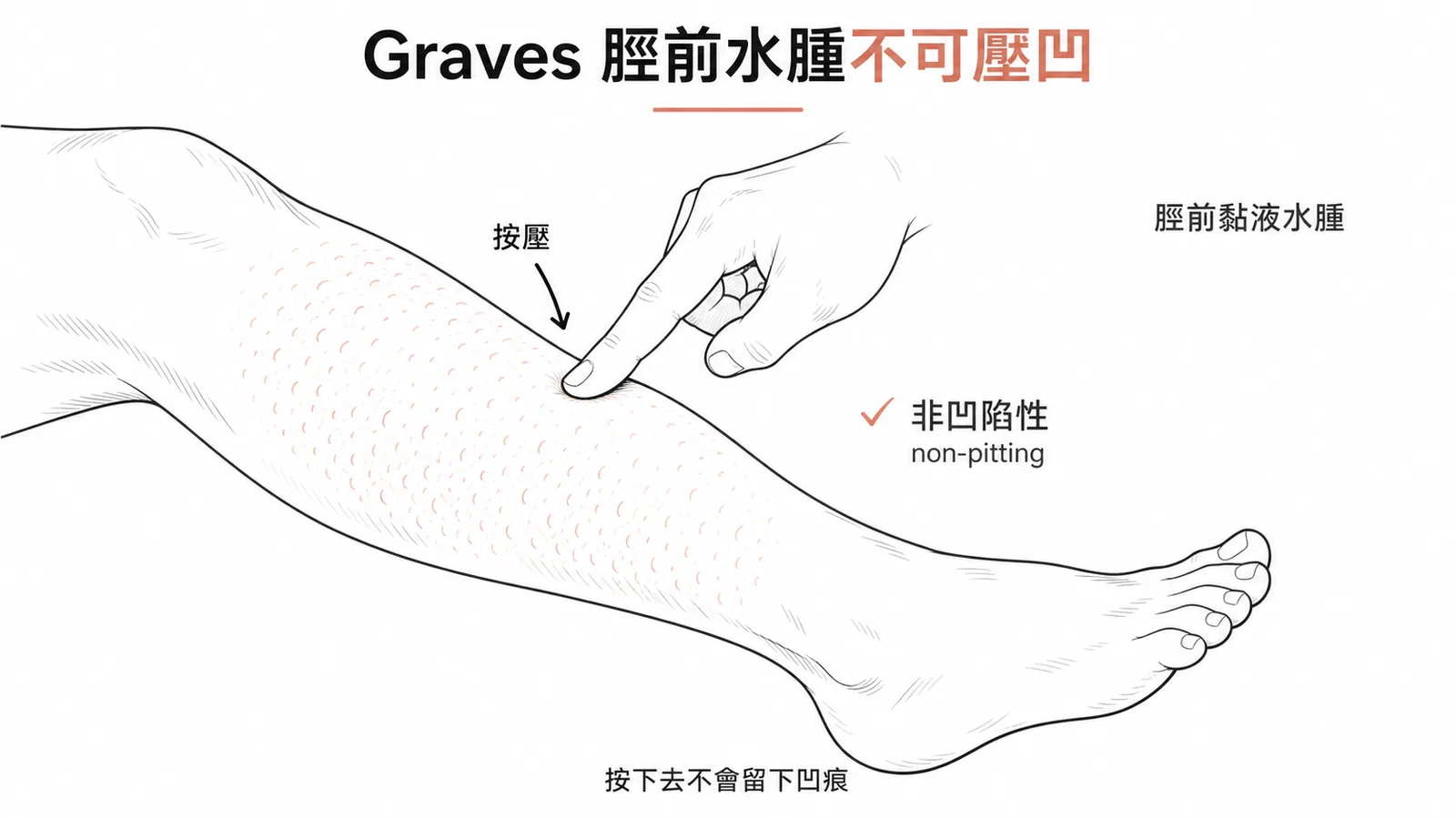 葛雷夫氏症的脛前黏液水腫是非凹陷性水腫而非可壓凹陷