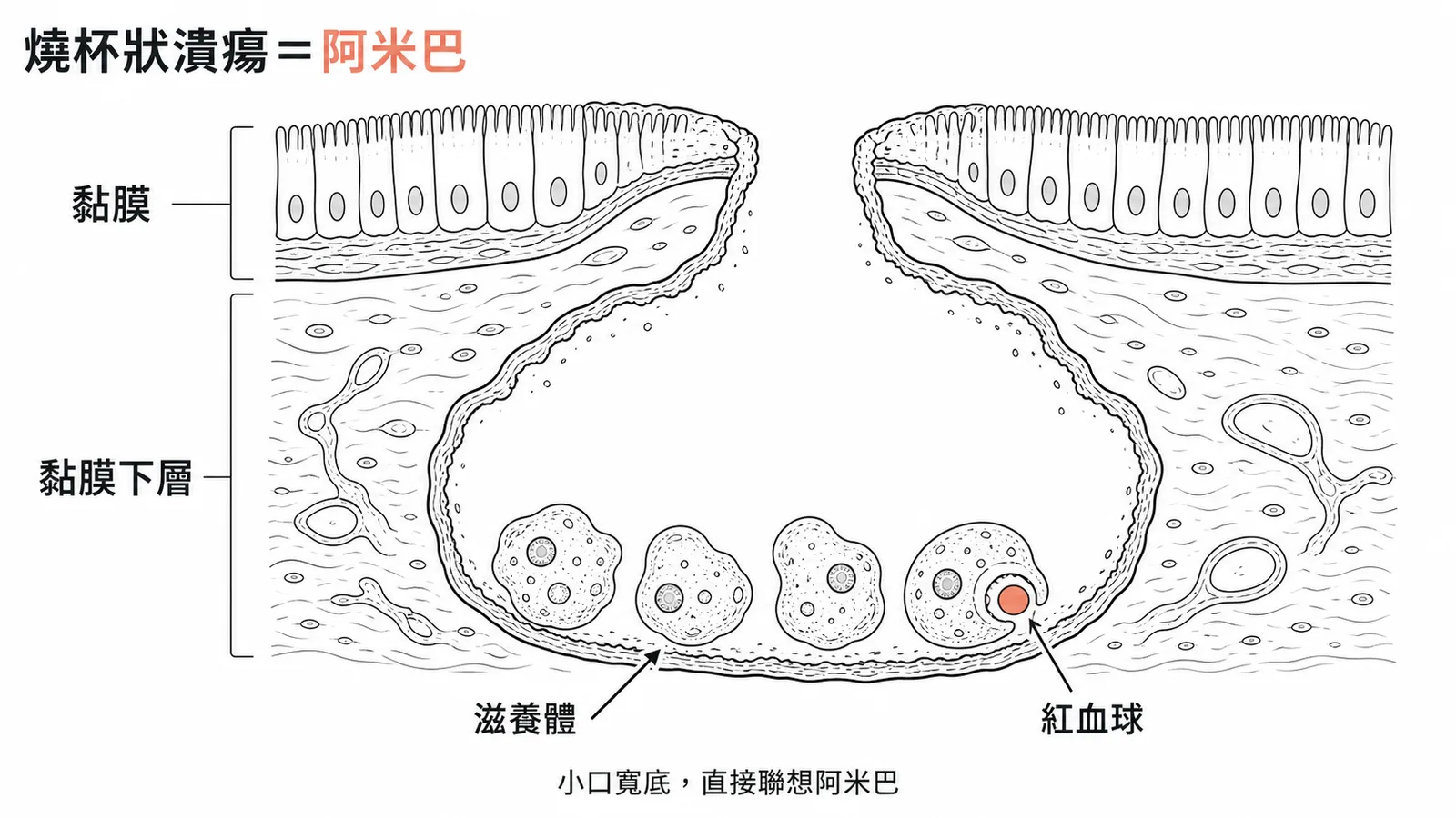 阿米巴痢疾診斷特徵:燒杯狀潰瘍與吞噬紅血球的滋養體