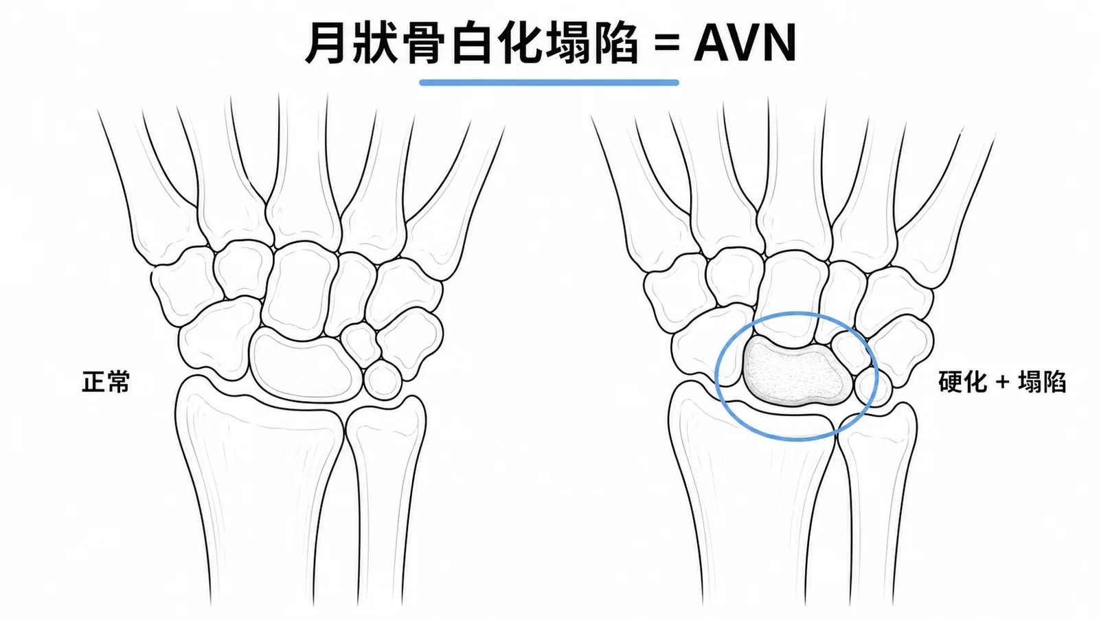 月狀骨缺血性壞死 Kienbock's disease：X光上月狀骨硬化塌陷