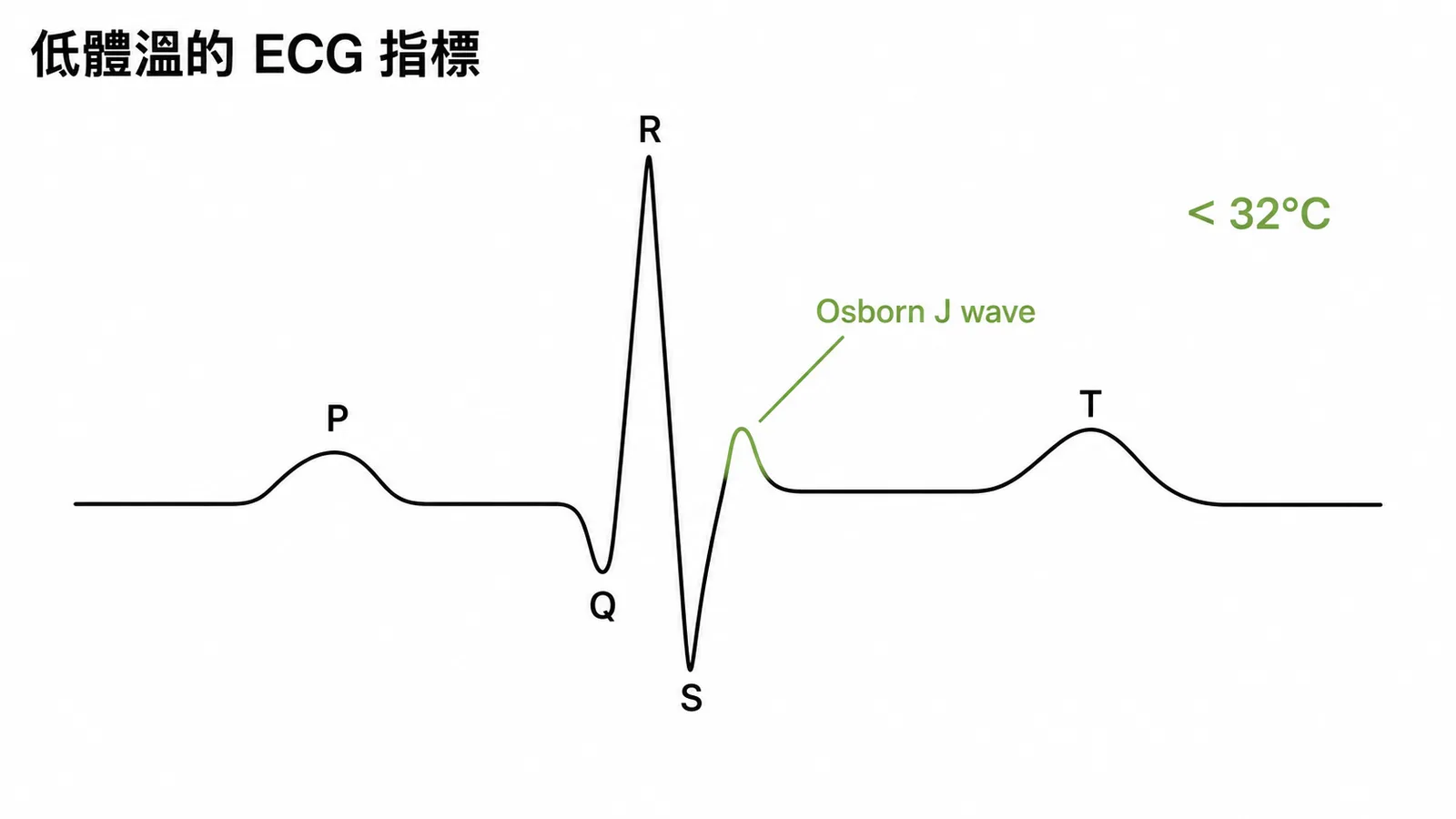 低體溫心電圖出現 Osborn J wave 的典型表現