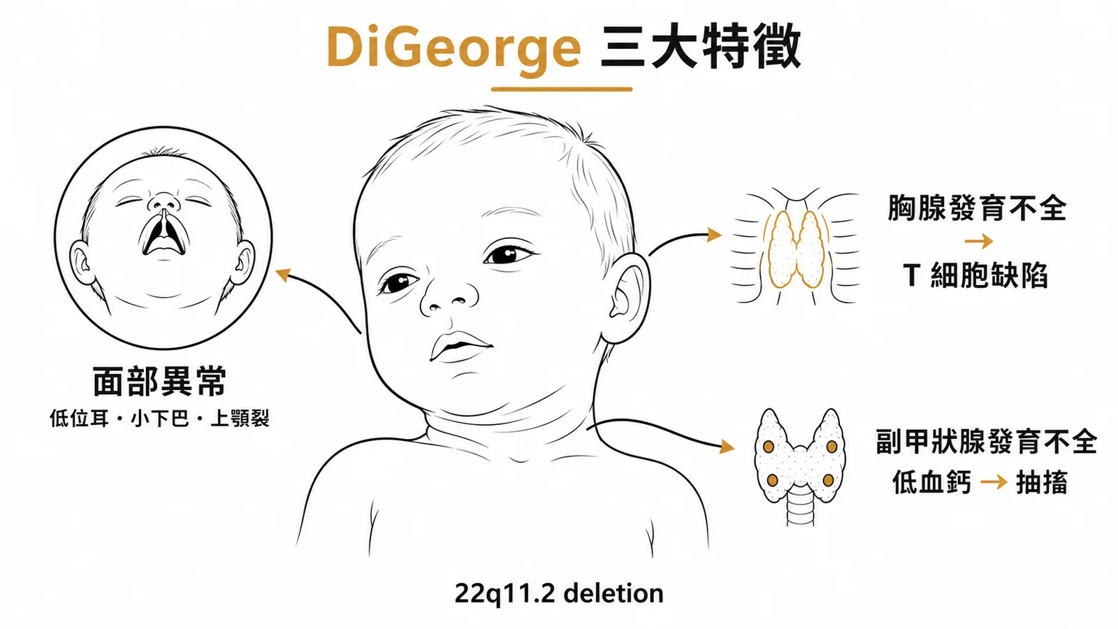 DiGeorge syndrome 三大特徵示意圖
