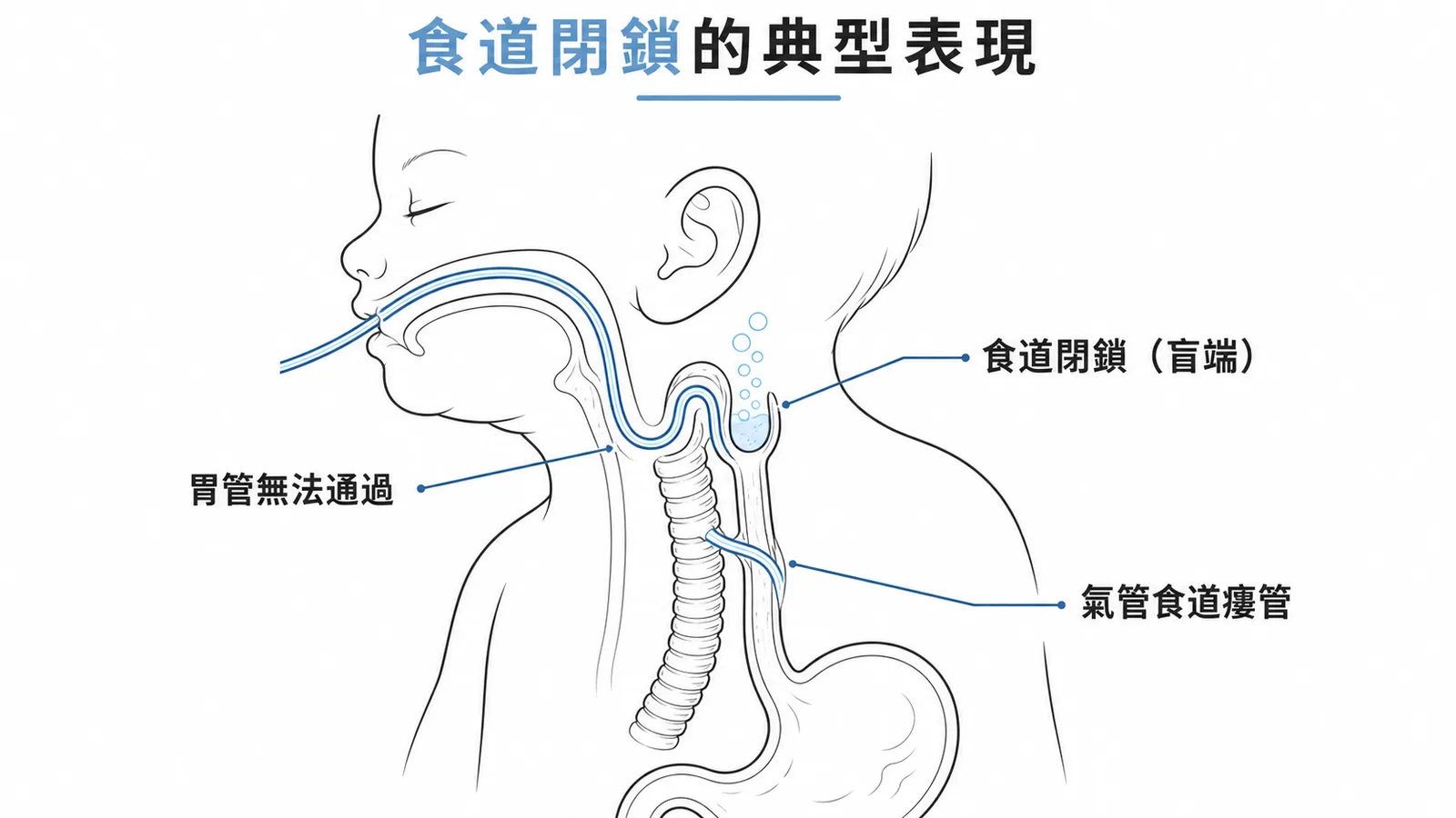 食道閉鎖合併氣管食道瘻管解剖示意圖