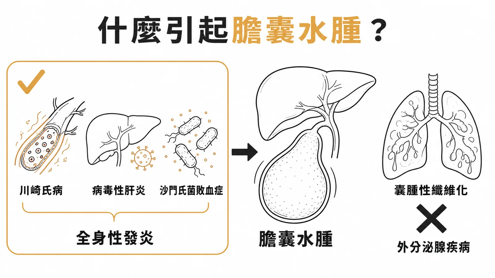 急性膽囊水腫的常見與罕見病因對比圖
