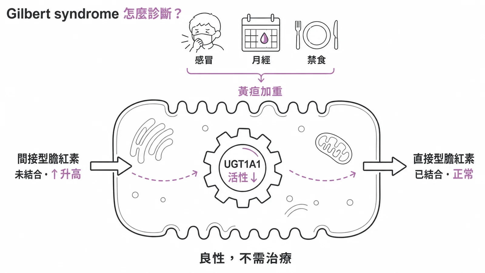 Gilbert syndrome 診斷要點與 UGT1A1 機轉示意圖