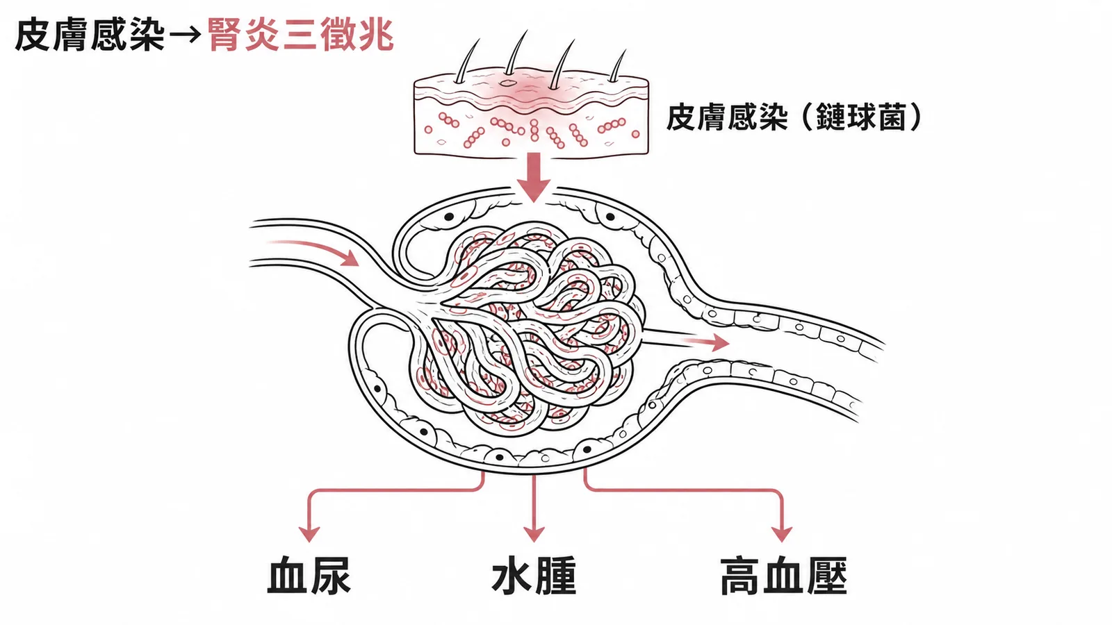皮膚鏈球菌感染後引發腎絲球腎炎,出現血尿、水腫、高血壓三大徵兆